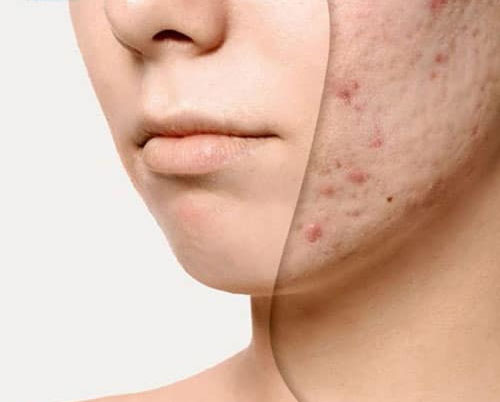 Trị Sẹo Thâm Tại Sen Beauty